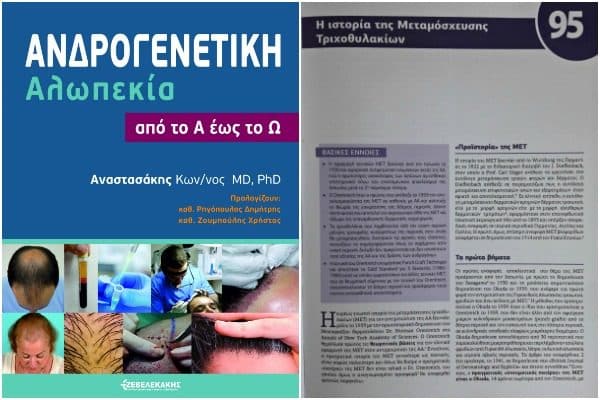ιστορια και εξελιξη της μεταμοσχευσης τριχοθυλακιων