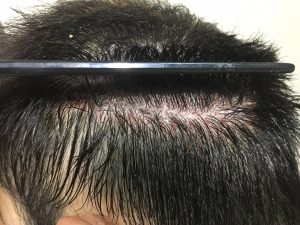 εξέταση περιοχής για μεταμόσχευση μαλλιών FUT