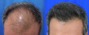 μεταμόσχευση μαλλιών FUT πριν και μετά