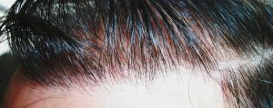 μεταμόσχευση μαλλιών hairline