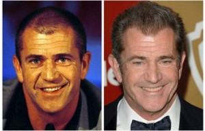 μεταμοσχευση μαλλιων Mel Gibson