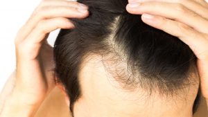 σημαντική ανακοίνωση από την ISHRS για την μεταμόσχευση μαλλιών