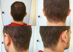 Εικόνα λήπτριας και δότριας περιοχής 12 μήνες μετά τη Μεταμόσχευση Μαλλιών FUE ασθενής μεταμόσχευσης μαλλιών