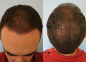 Εικόνα λήπτριας και δότριας περιοχής 12 μήνες μετά τη Μεταμόσχευση Μαλλιών FUE μπρος-πίσω ασθενής μεταμόσχευσης μαλλιών(1)