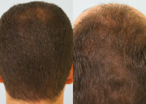 Εικόνα λήπτριας και δότριας περιοχής 18 μήνες μετά τη Μεταμόσχευση Μαλλιών FUE ασθενής μεταμόσχευσης μαλλιών