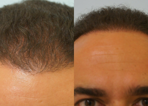 Εικόνα λήπτριας και δότριας περιοχής 18 μήνες μετά τη Μεταμόσχευση Μαλλιών FUE μπροστά ασθενής μεταμόσχευσης μαλλιών
