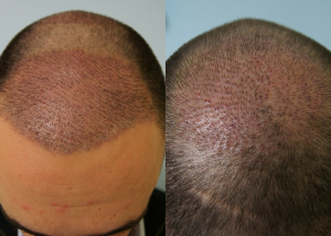 Εικόνα λήπτριας και δότριας περιοχής την 7η ημέρα ασθενής μεταμόσχευσης μαλλιών