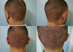 Εικόνα λήπτριας και δότριας περιοχής την 7η ημέρα δεύτερη λήψη ασθενής μεταμόσχευσης μαλλιών