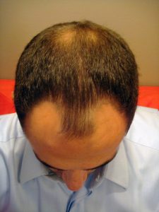 εικόνα μαλλιών ασθενής μεταμόσχευσης μαλλιών 2006