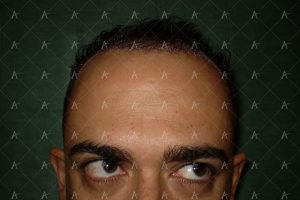 Πριν και μετά τη 2η συνεδρία FUE, 1200 μοσχευμάτων 5/6 ασθενής μεταμόσχευσης μαλλιών