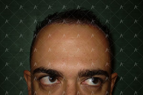 Πριν και μετά τη 2η συνεδρία FUE, 1200 μοσχευμάτων 5/6 ασθενής μεταμόσχευσης μαλλιών