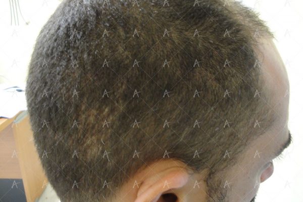 Εικόνα λήπτριας και δότριας περιοχής 2 μήνες μετά την επέμβαση 6/7 ασθενής μεταμόσχευσης μαλλιών
