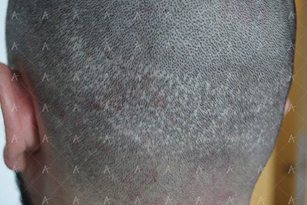 Κούρεμα δότριας περιοχής 2/4 ασθενής μεταμόσχευσης μαλλιών