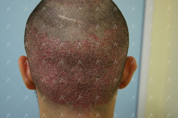 Εικόνα λήπτριας και δότριας περιοχής τη 2η μετεγχειρητική ημέρα 5/6 ασθενής μεταμόσχευσης μαλλιών