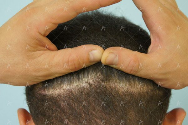 Εικόνα λήπτριας και δότριας περιοχής 18 μήνες μετά τη Μεταμόσχευση Μαλλιών FUE 5/6 ασθενής μεταμόσχευσης μαλλιών