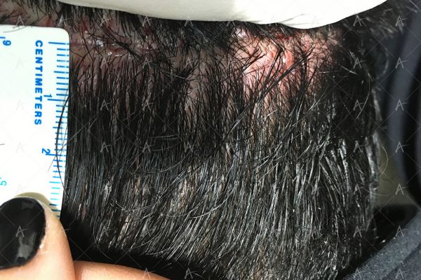 Επούλωση FUT 5/7 ασθενής μεταμόσχευσης μαλλιών