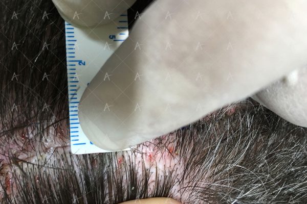 Επούλωση FUT 6/7 ασθενής μεταμόσχευσης μαλλιών