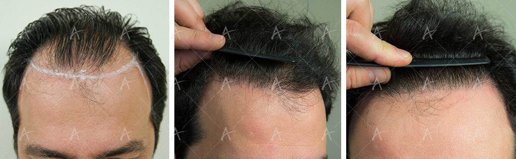 έρευνα για τη μεταμόσχευση μαλλιών παρουσιάζει παγκόσμια αύξηση στις επεμβάσεις