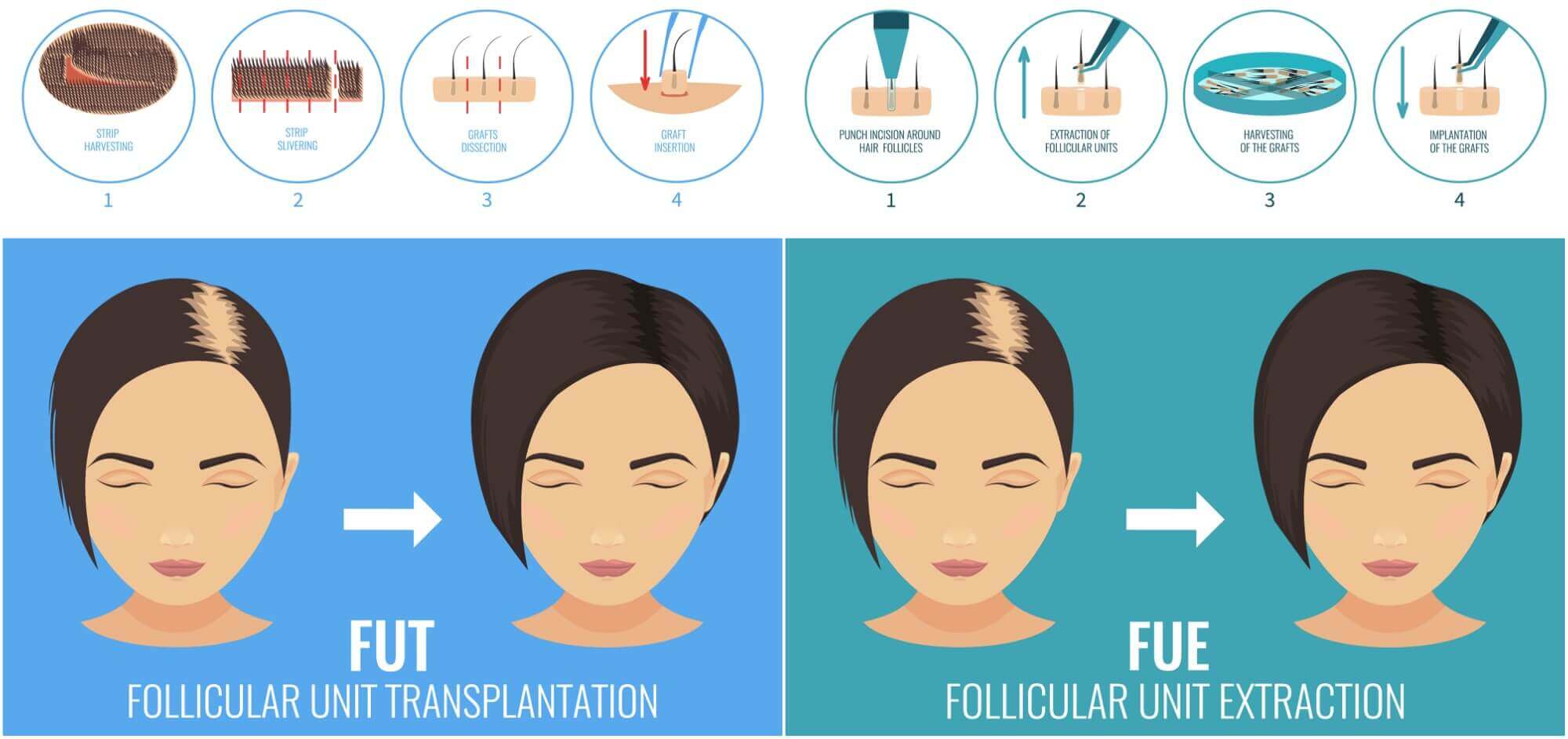 Μεταμόσχευση μαλλιών στις γυναίκες καταλληλότητα ασθενούς