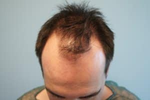 3500 fus - before hair transplantation