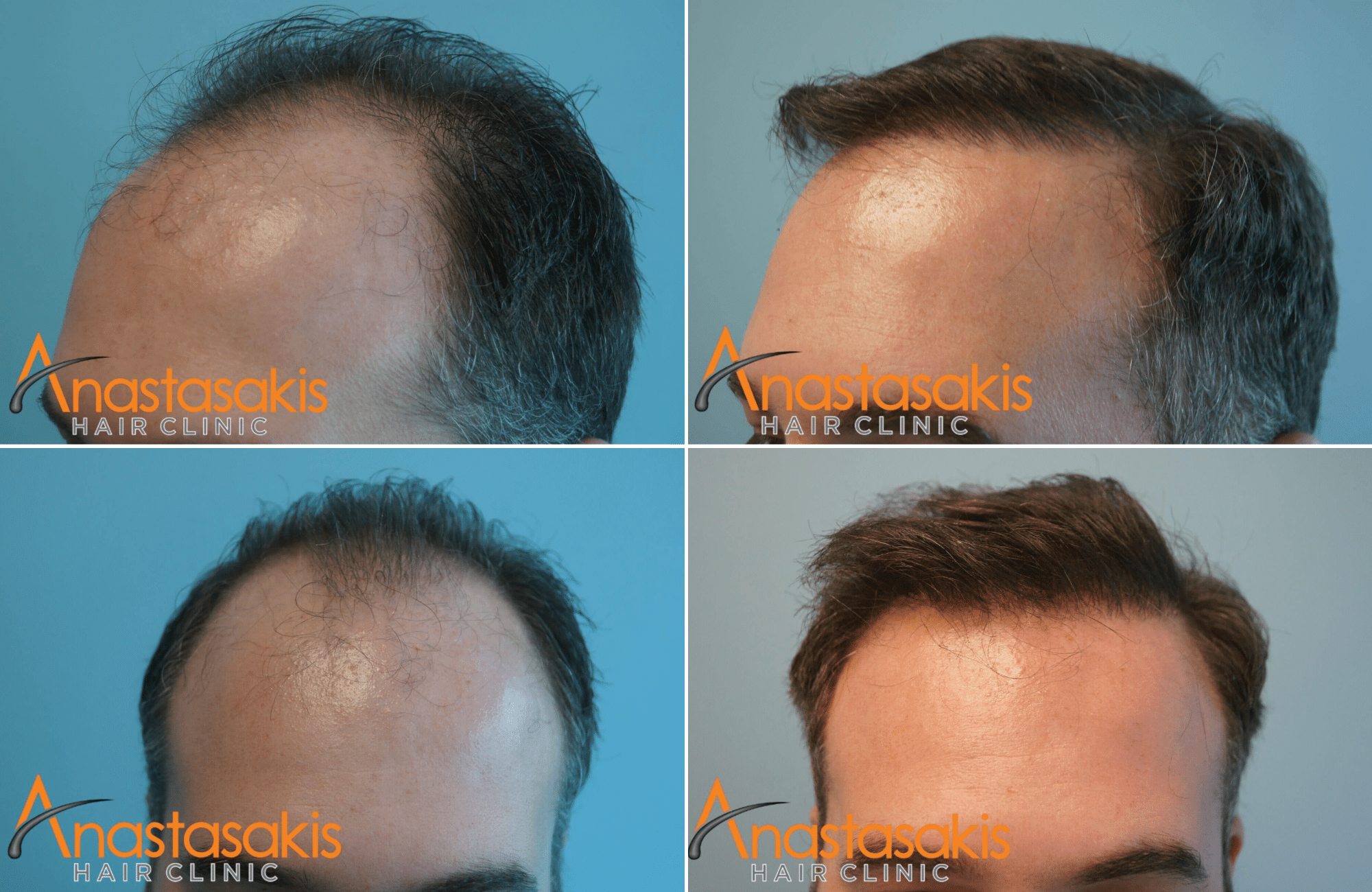 https://www.anastasakishairclinic.gr/portfolio/apotelesma-me-2500fus-2/