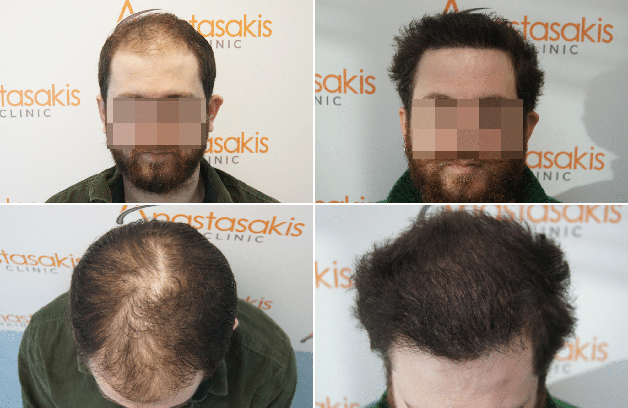 https://www.anastasakishairclinic.gr/portfolio/apotelesma-metamosxefsis-mallion-anastasakis-hair-clinic-2400fus/