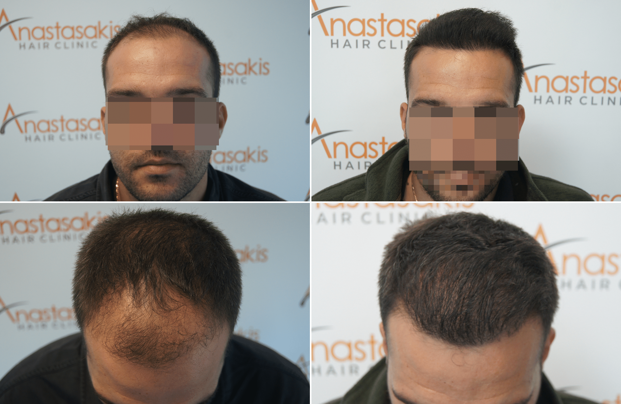 https://www.anastasakishairclinic.gr/portfolio/hair-transplant-result-with-2500fus-thickenning/