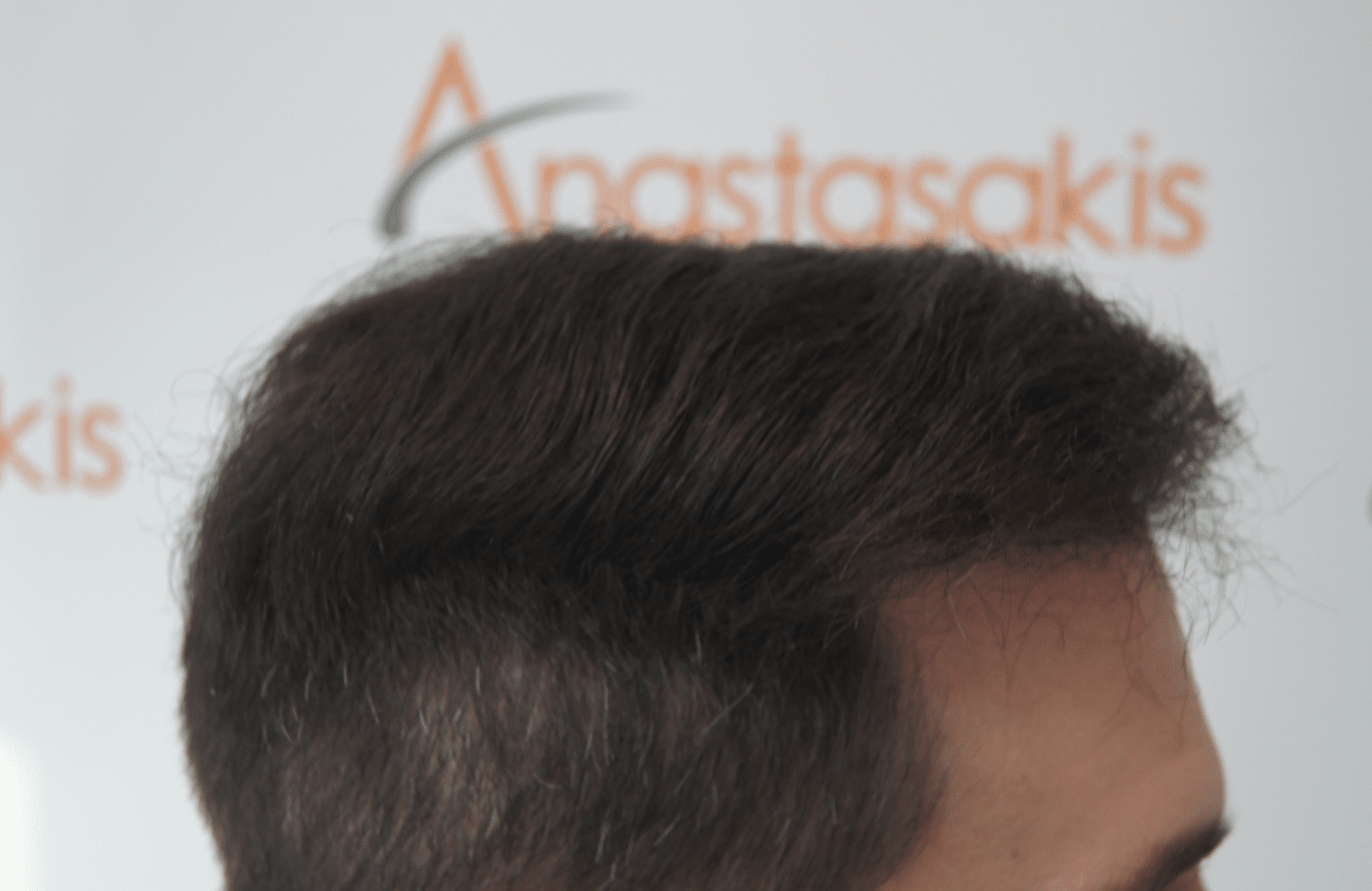 απολυτα φυσικό αποτελεσμα στη μεταμόσχευση μαλλιων στην anastasakis hair clinic ΜΕ 2500 ΤΡΙΧΟΘΥΛΑΚΙΑ