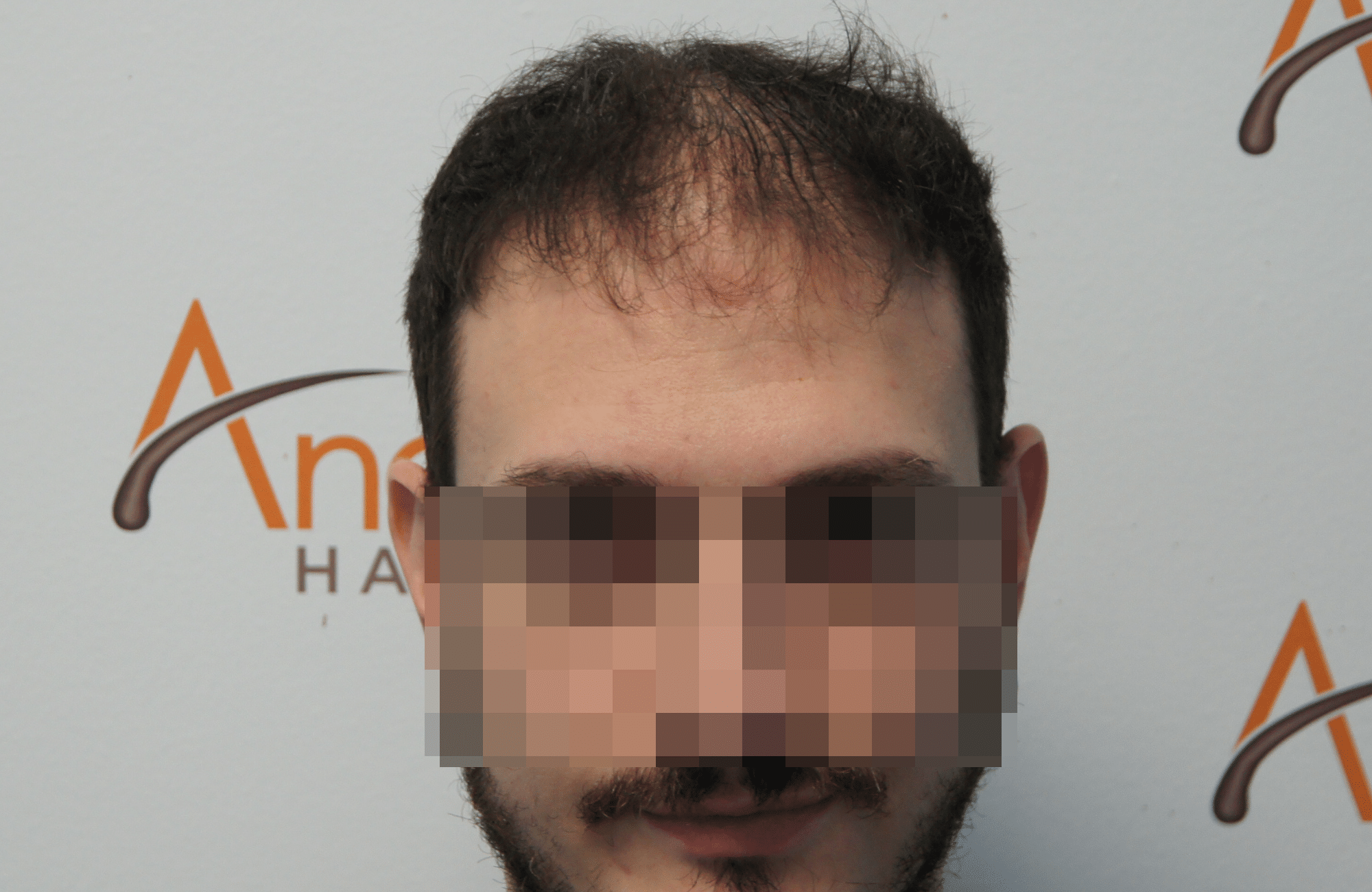 απολυτα φυσικό αποτελεσμα στη μεταμόσχευση μαλλιων στην anastasakis hair clinic ΜΕ 2500 ΤΡΙΧΟΘΥΛΑΚΙΑ