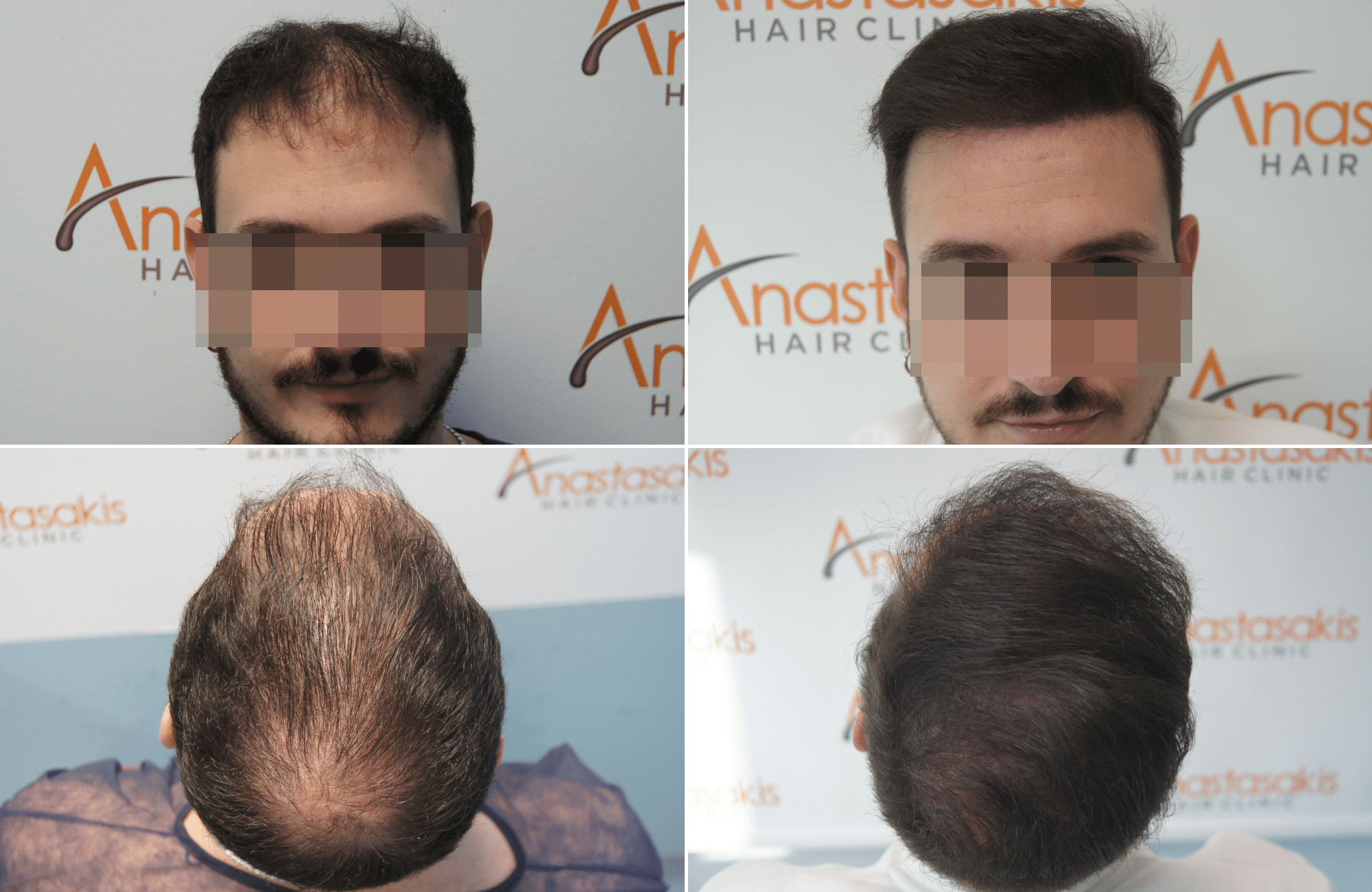 https://www.anastasakishairclinic.gr/portfolio/3300-fus-fut-anastasakis-hair-clinic/