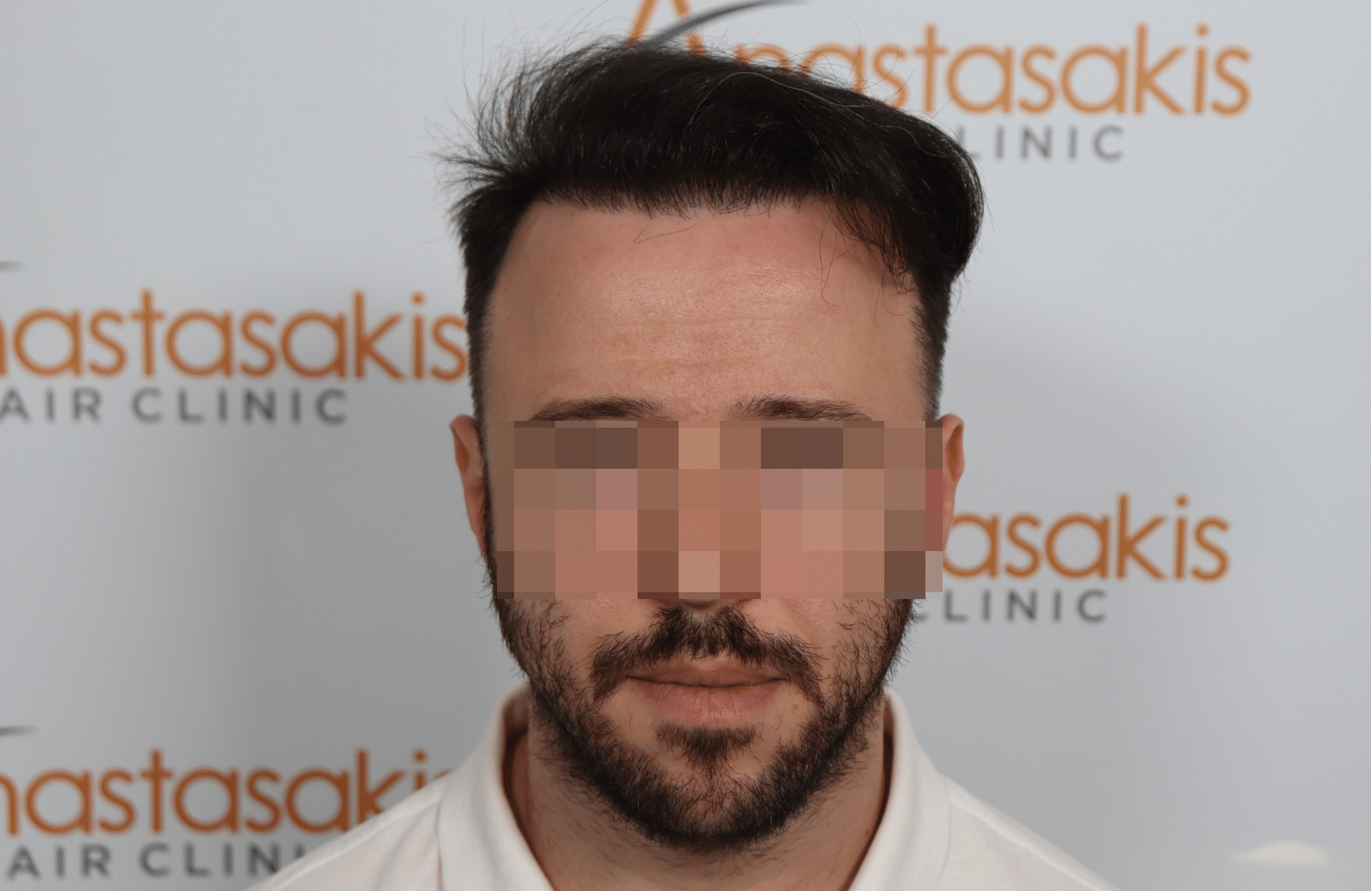 hair transplant result with 2600 fus with fue anastasakis after fullface