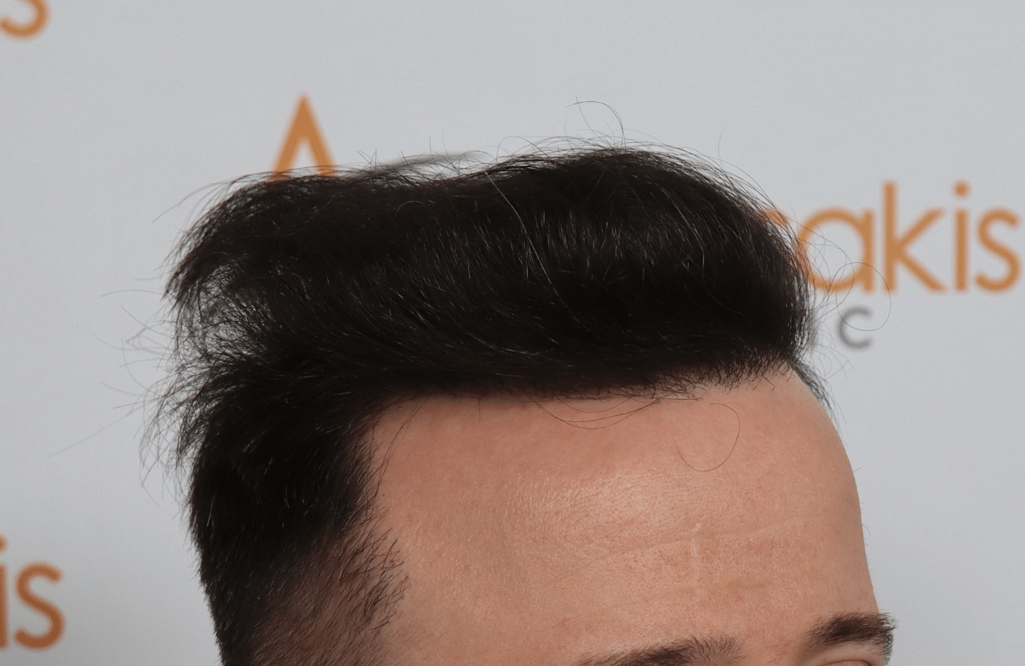 hair transplant result with 2600 fus with fue anastasakis after side1