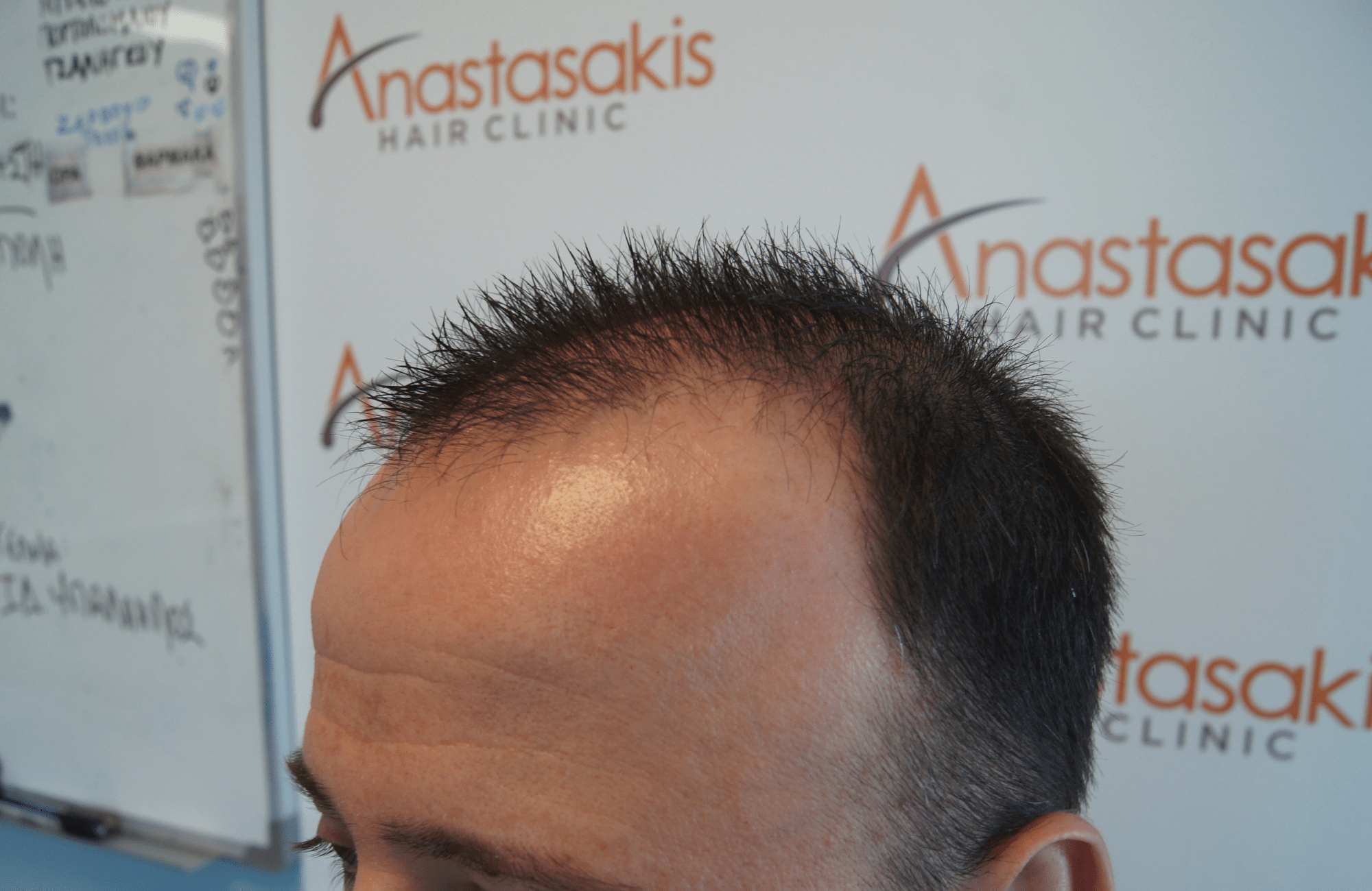 hair transplant result with 2600 fus with fue anastasakis before side2
