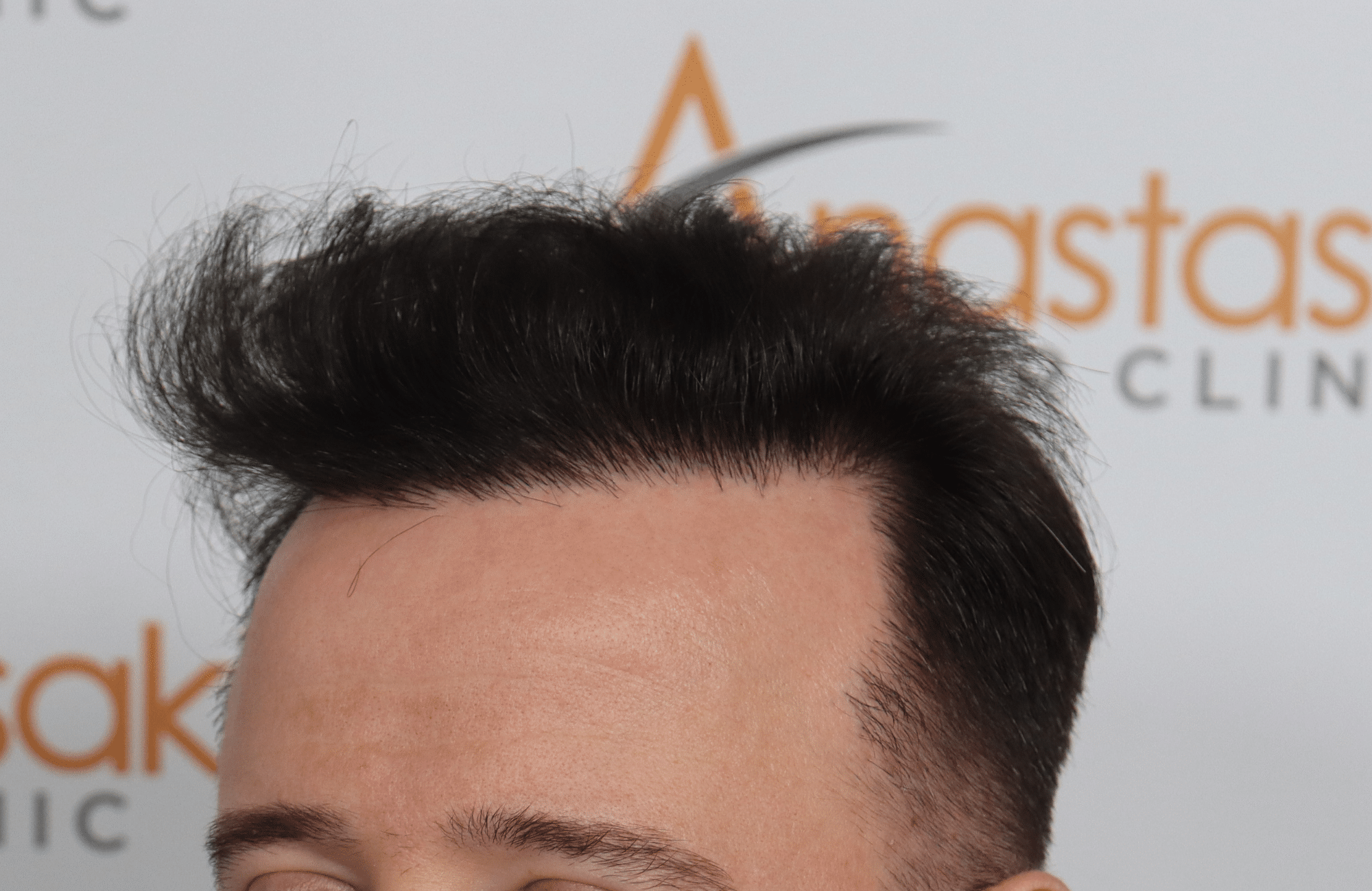 hair transplant result with 2600 fus with fue anastasakis after side2