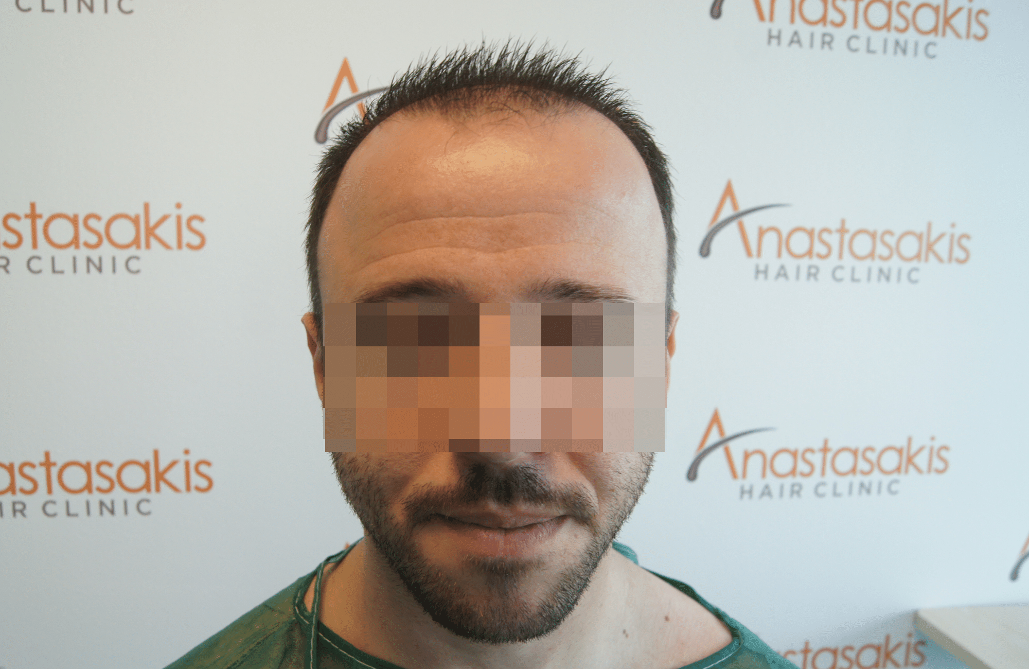 hair transplant result with 2600 fus with fue anastasakis before fullface