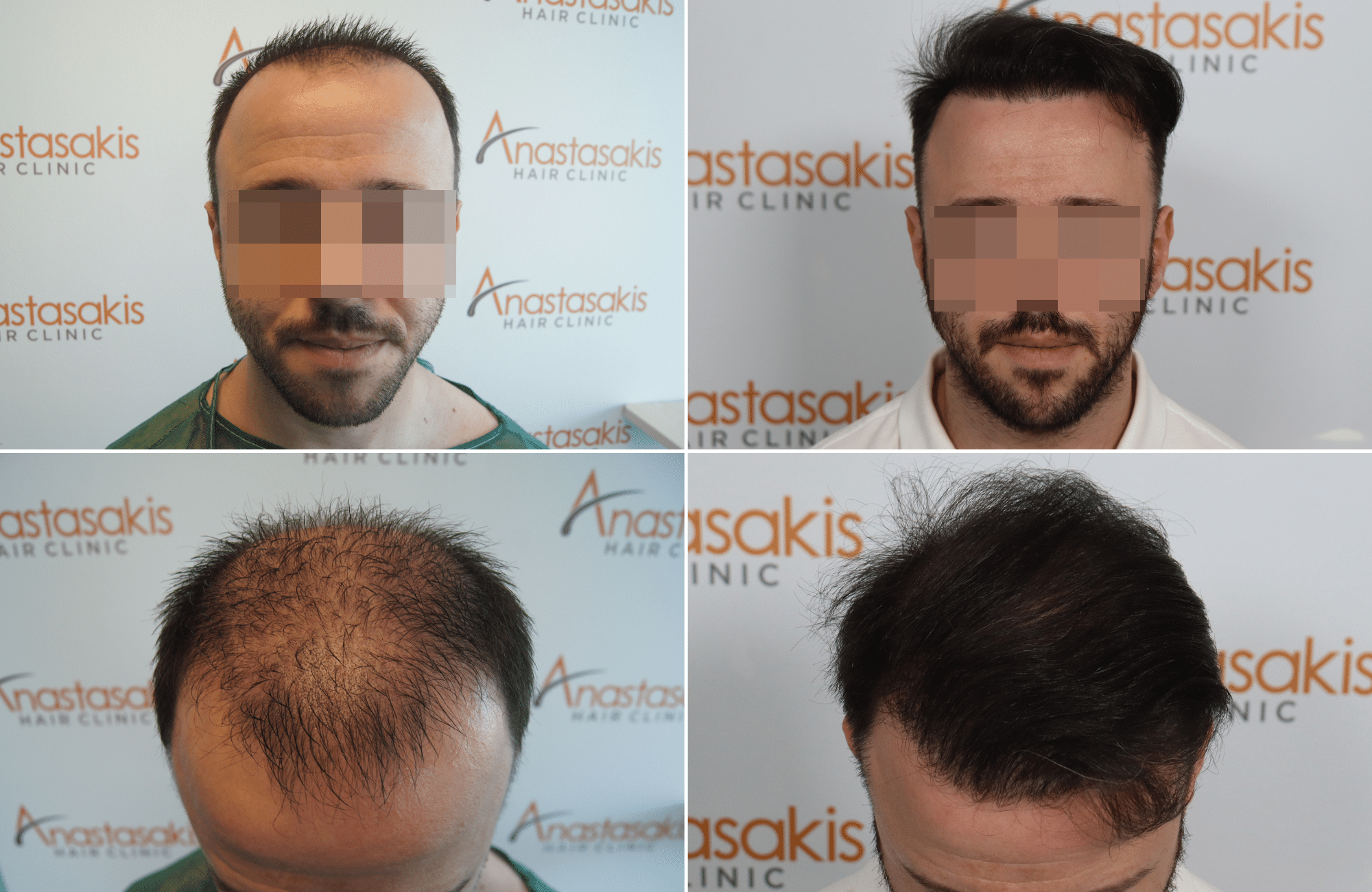 https://www.anastasakishairclinic.gr/portfolio/apotelesma-2590-fus/