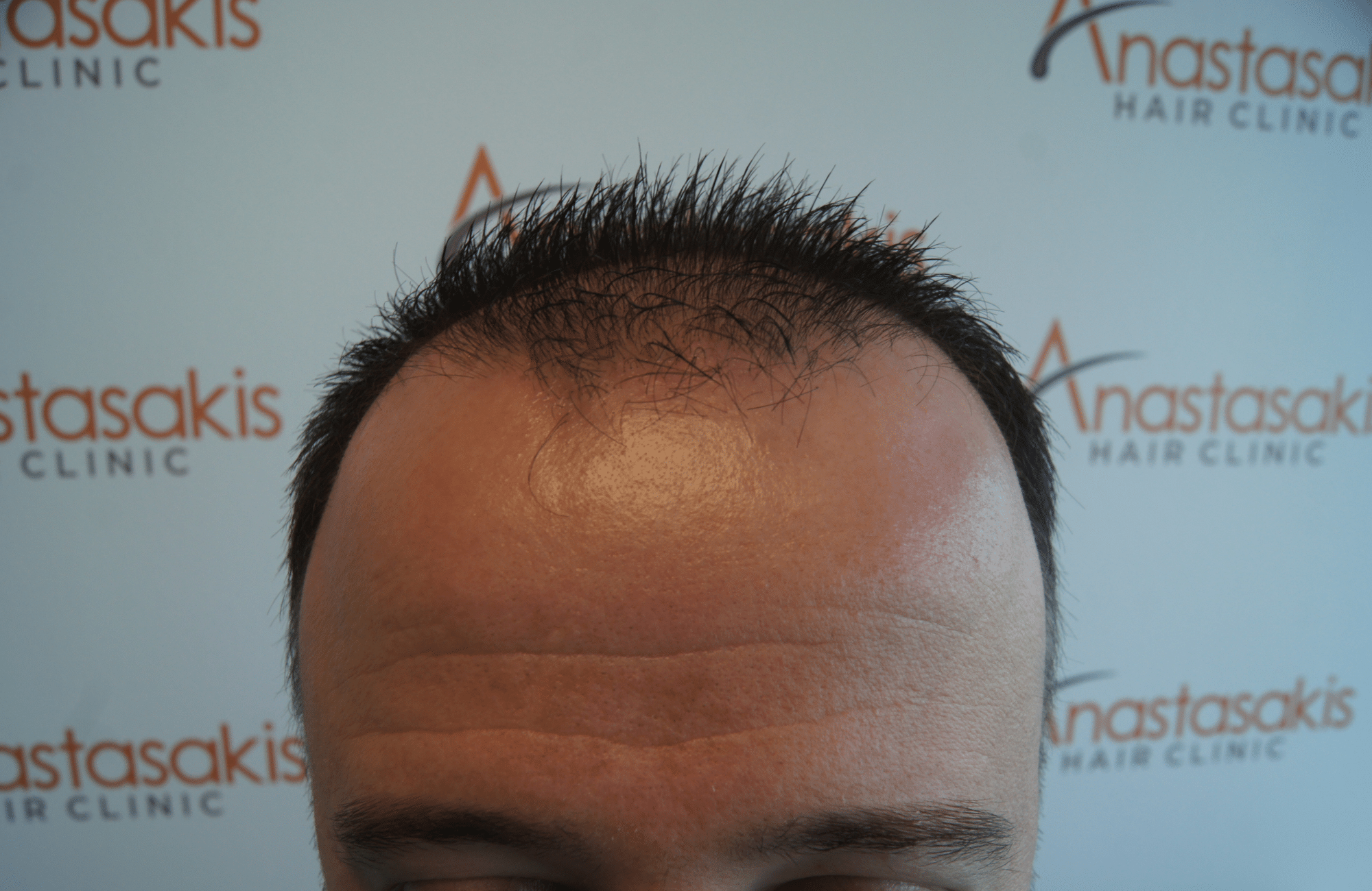 hair transplant result with 2600 fus with fue anastasakis before hairline