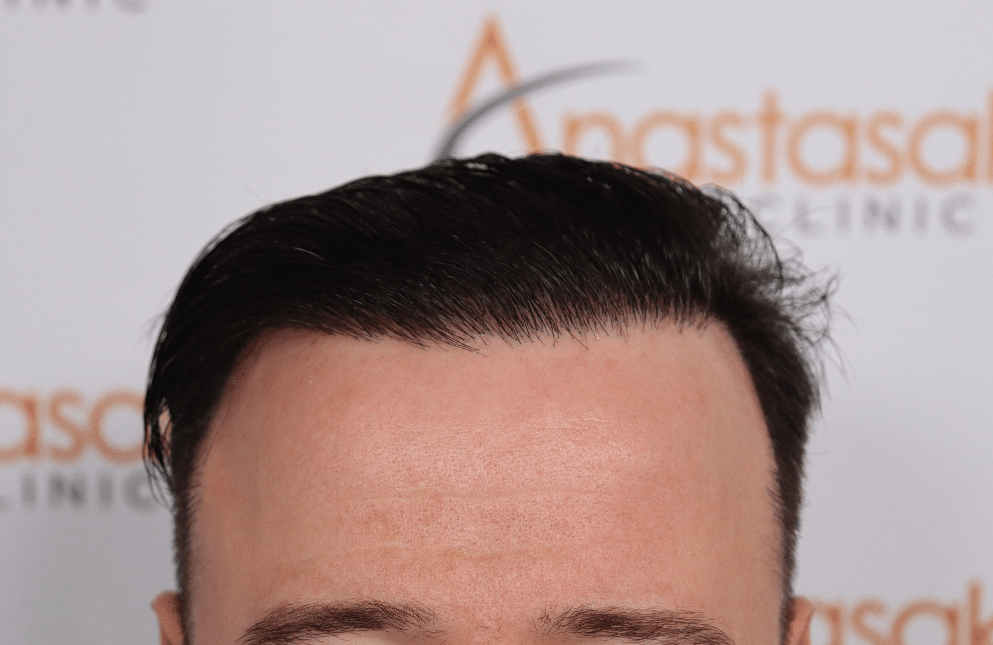 hair transplant result with 2600 fus with fue anastasakis after hairline