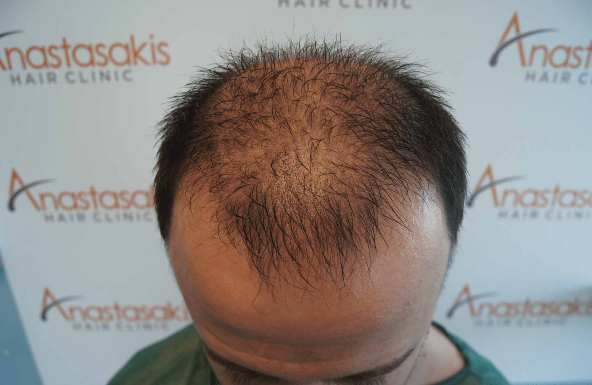 hair transplant result with 2600 fus with fue anastasakis before frontal