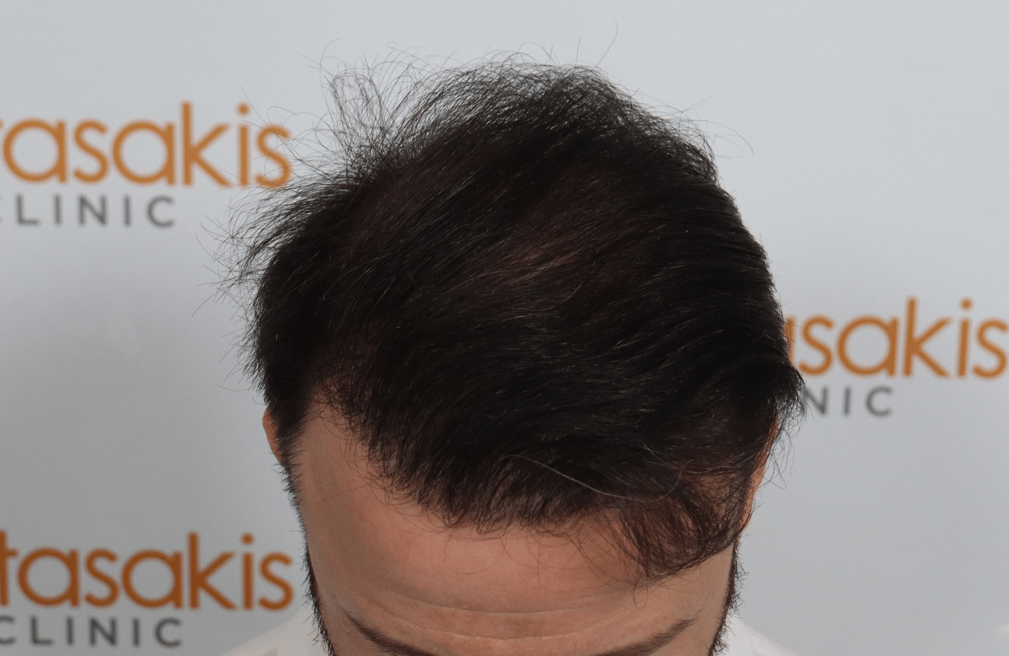 hair transplant result with 2600 fus with fue anastasakis after frontal