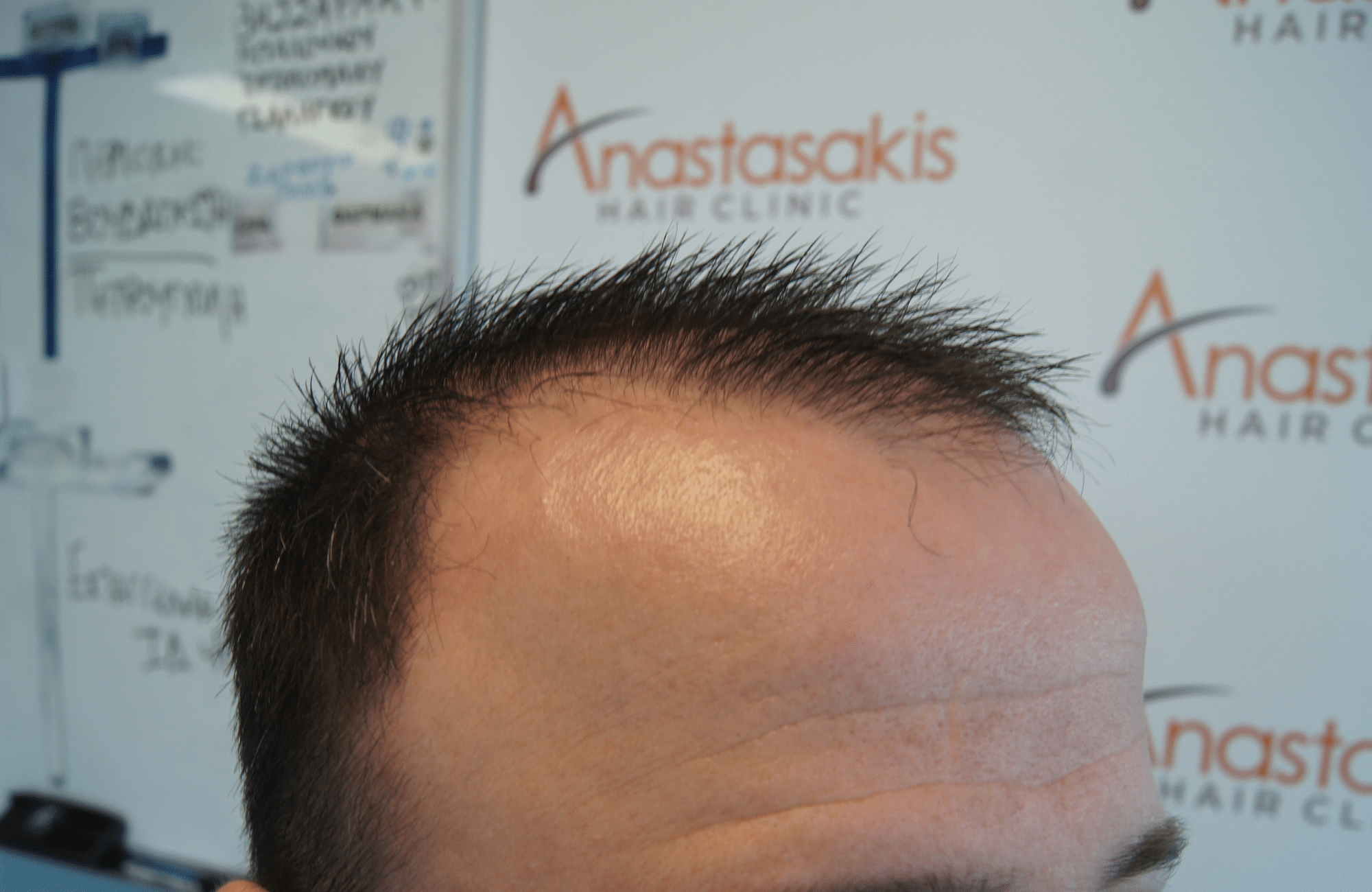 hair transplant result with 2600 fus with fue anastasakis before side1