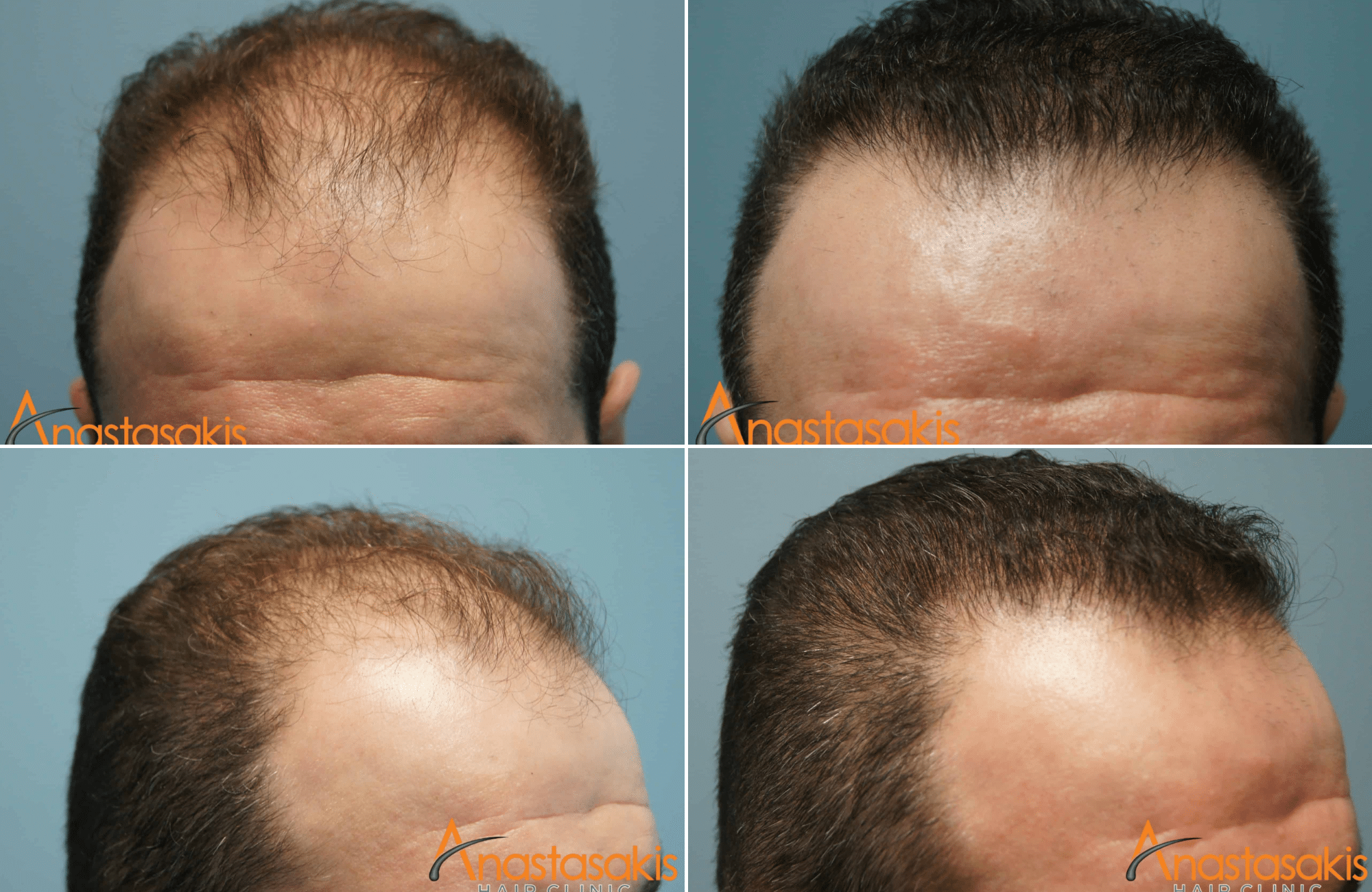 https://www.anastasakishairclinic.gr/portfolio/fut-2000fus-peristatikomm-anastasakis-hair-clinic/