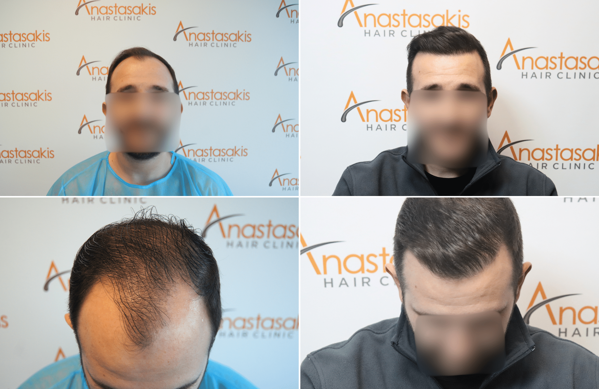 https://www.anastasakishairclinic.gr/portfolio/fut-2000fus-peristatikomm-anastasakis-hair-clinic/