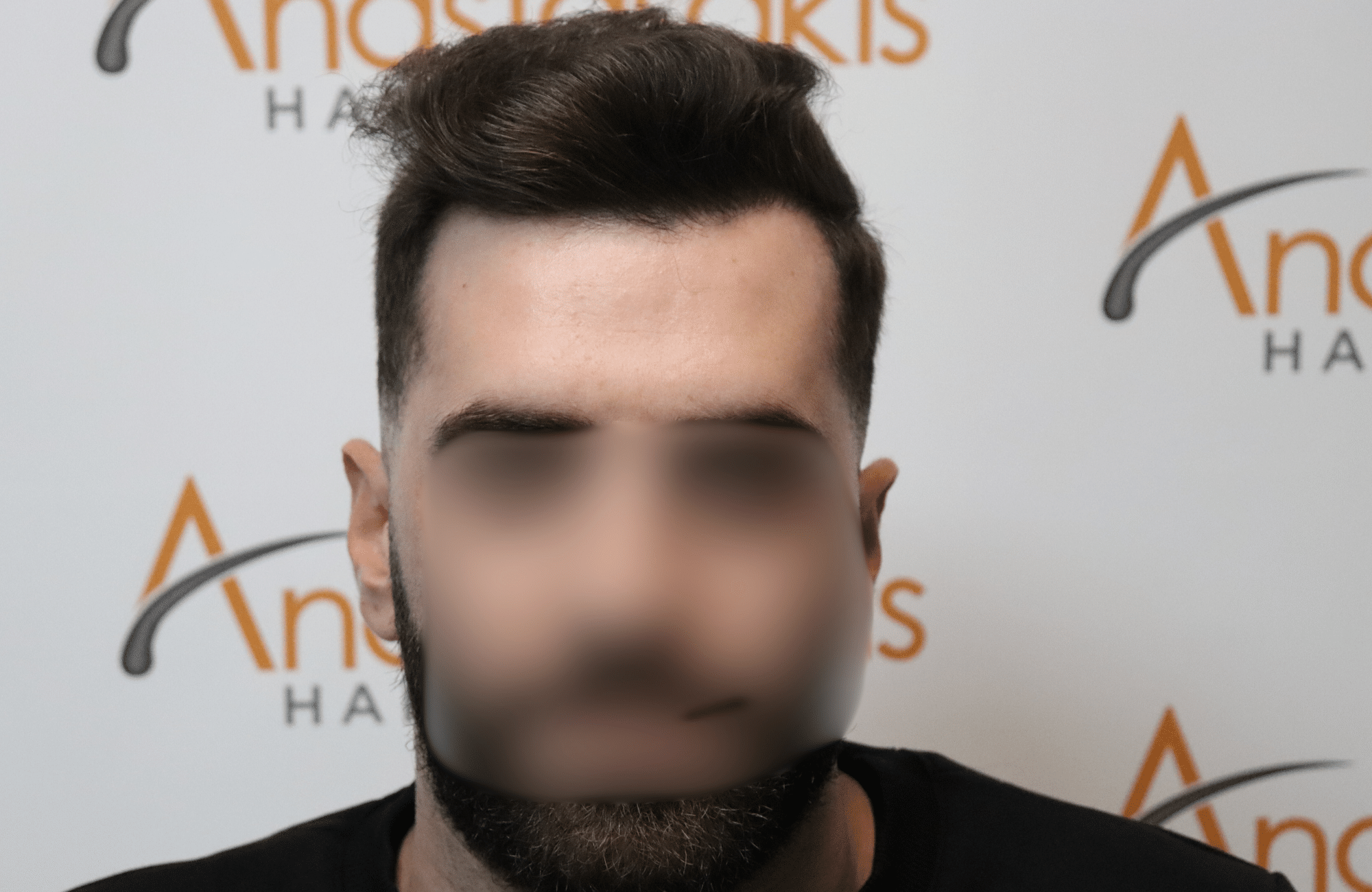 hair transplant result