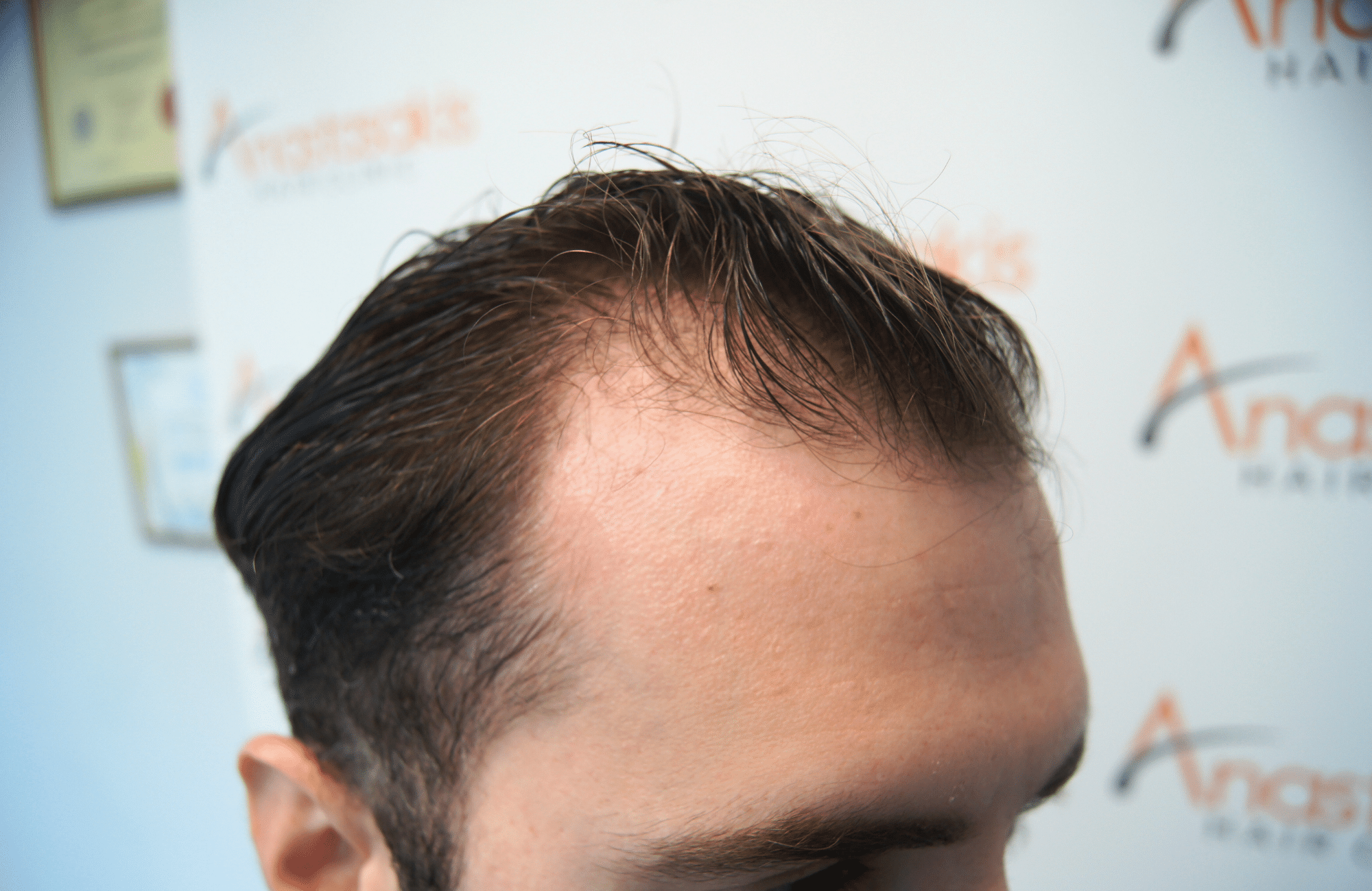 hair transplant result