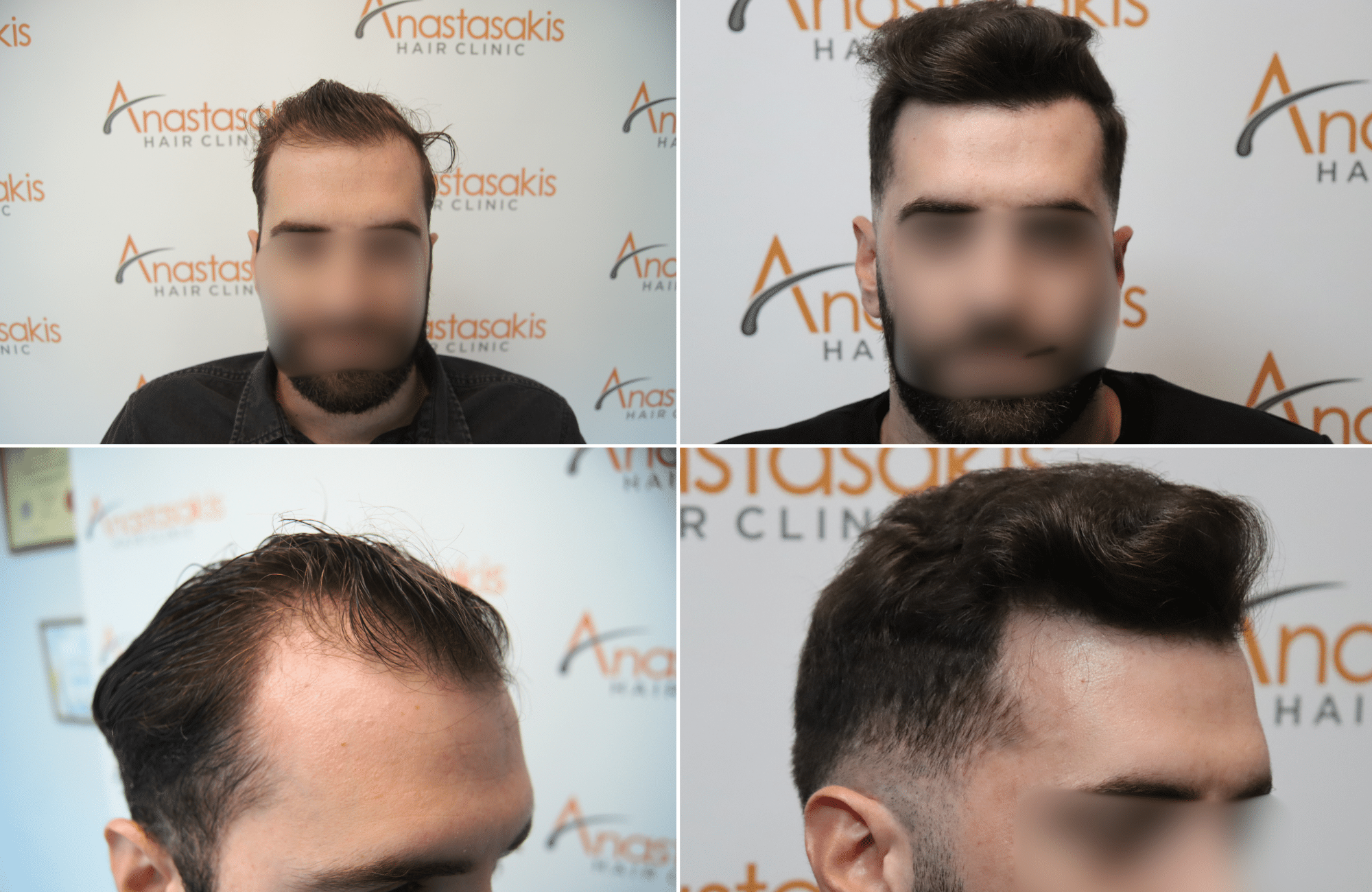https://www.anastasakishairclinic.gr/portfolio/%ce%b1%cf%80%ce%bf%cf%84%ce%ad%ce%bb%ce%b5%cf%83%ce%bc%ce%b1-%ce%bc%ce%b5-3020-fus/