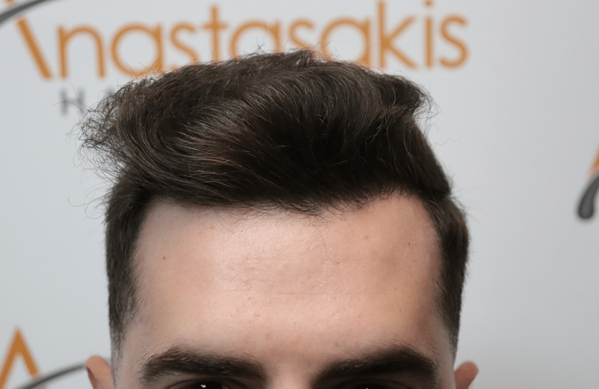hair transplant result
