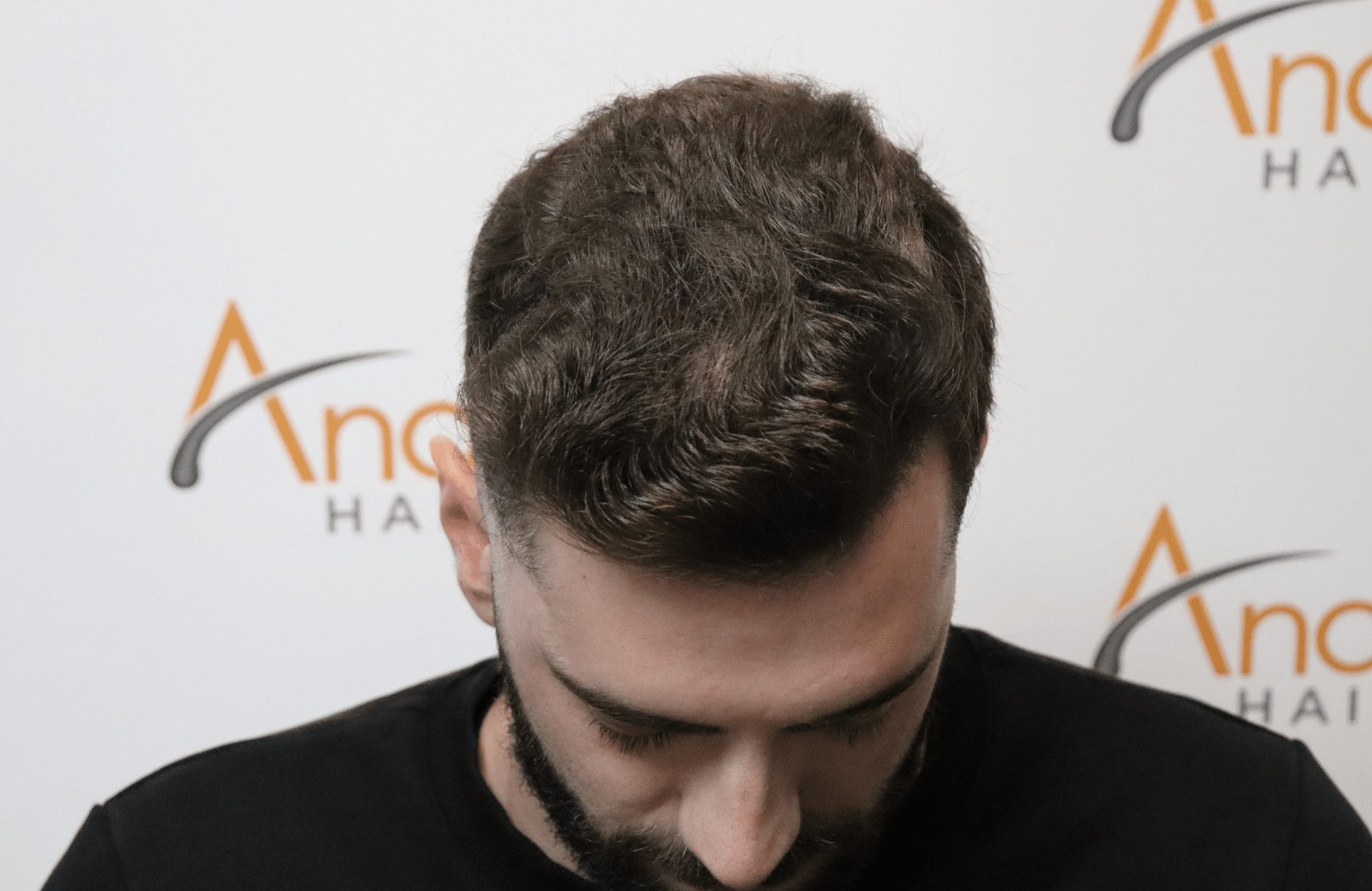 hair transplant result