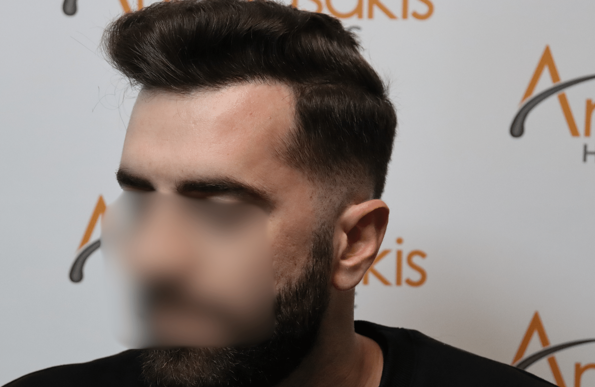 hair transplant result