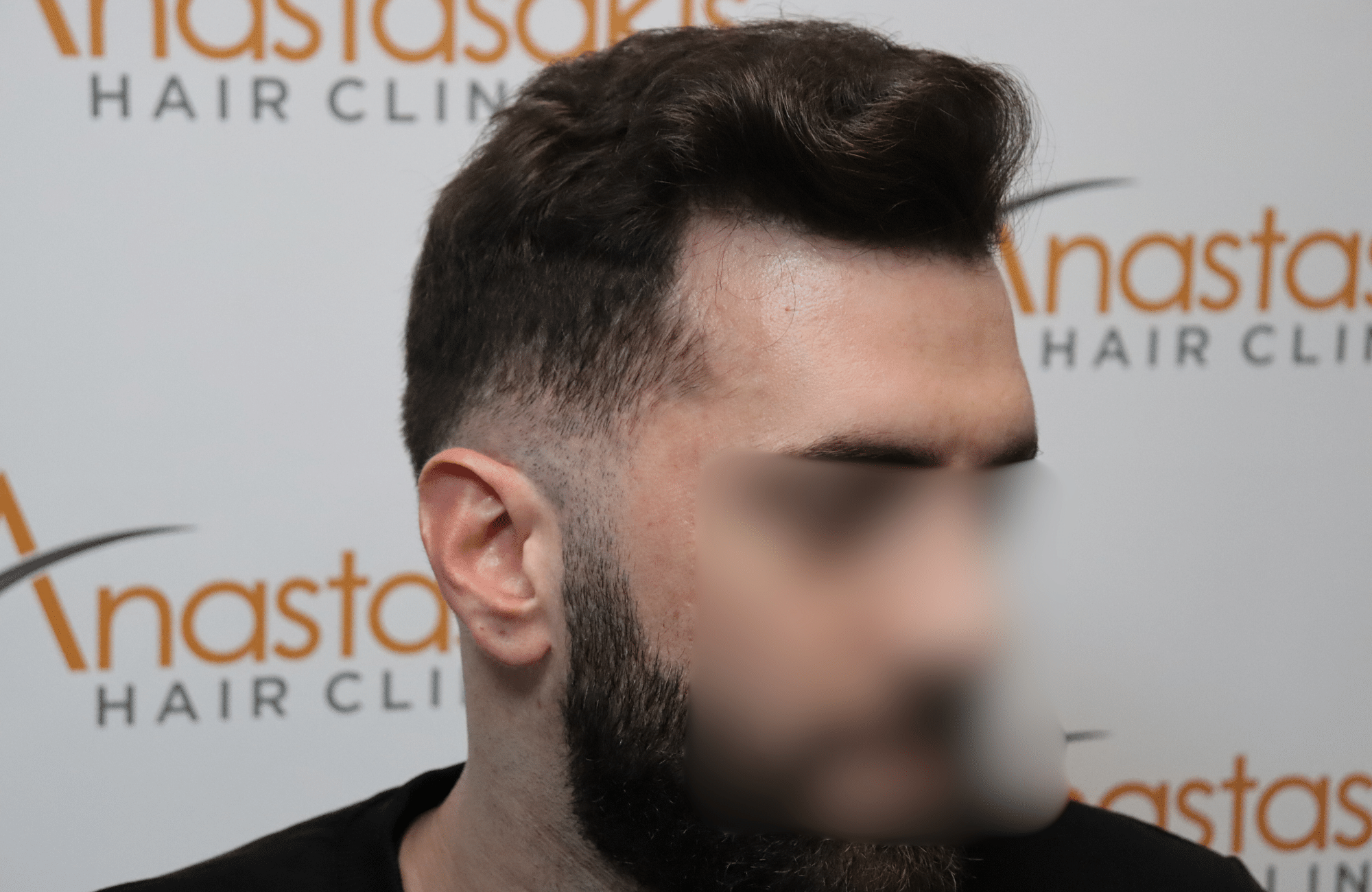 hair transplant result